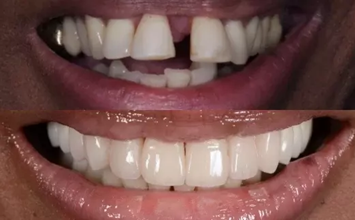 Before and after porcelain veneers