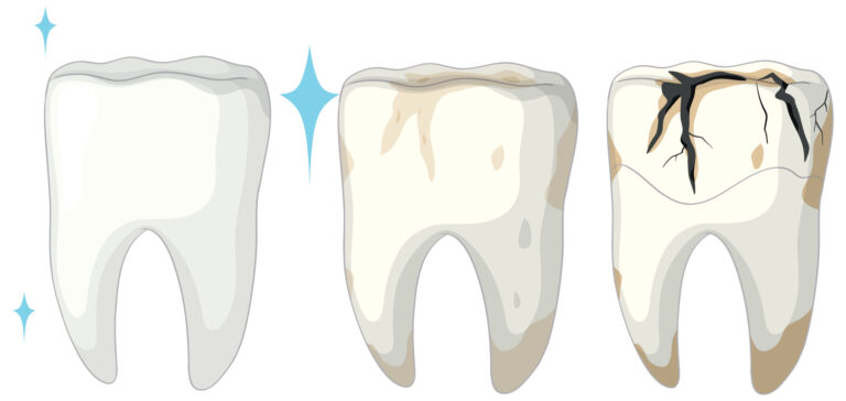 Healthy, stained, and cracked tooth comparison