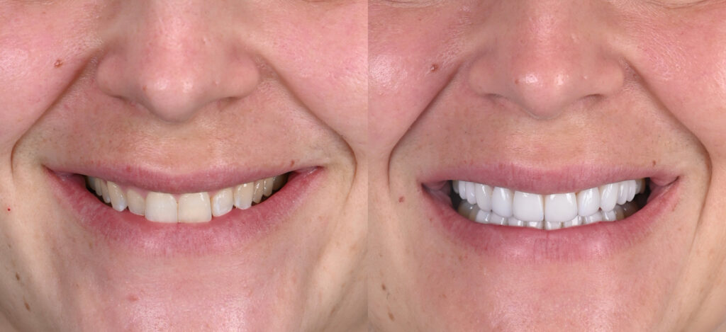 Before and after cosmetic veneers