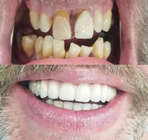 Before and after dentures