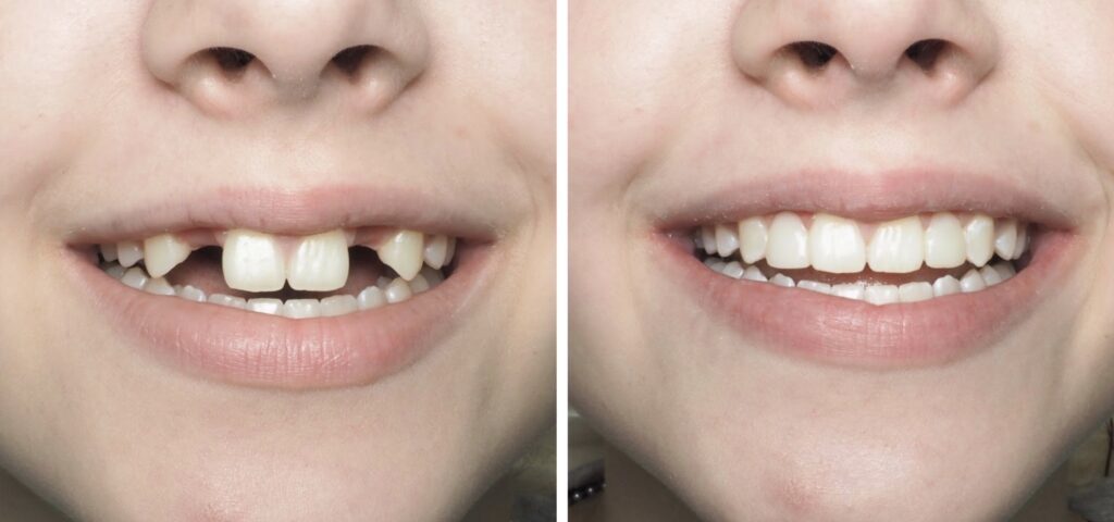 Before and after dental implant