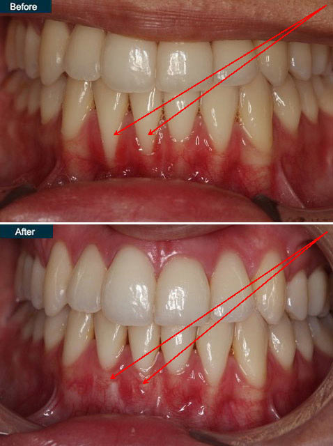 Before and after periodontal gum disease treatment