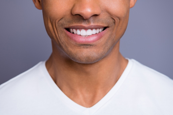 Natural-looking smile with porcelain veneers