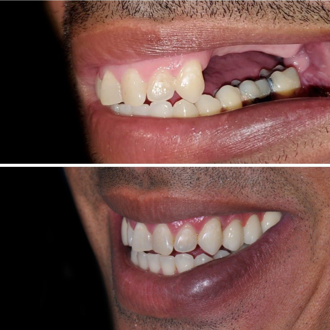 Before and after a porcelain bridge