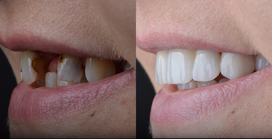 Before and after two single implants
