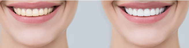 Fast Dental Treatments That Work to Improve Your Smile