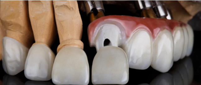 Fast Dental Treatments That Work to Improve Your Smile