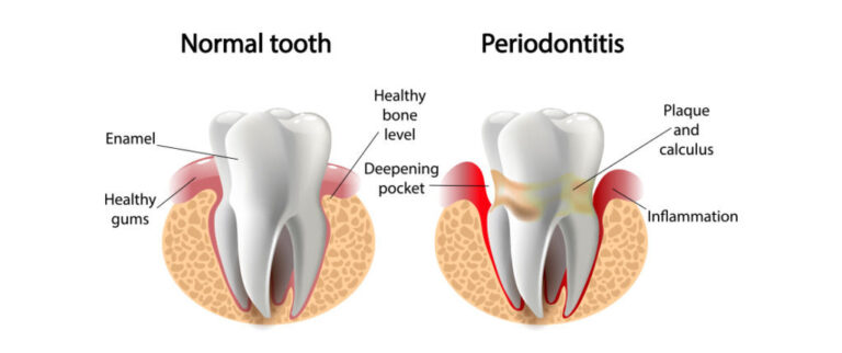 Bright Smile Dental Hygiene Tips from Yogi Dental Experts