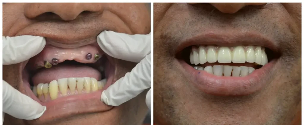 Before and after implants replacing a denture