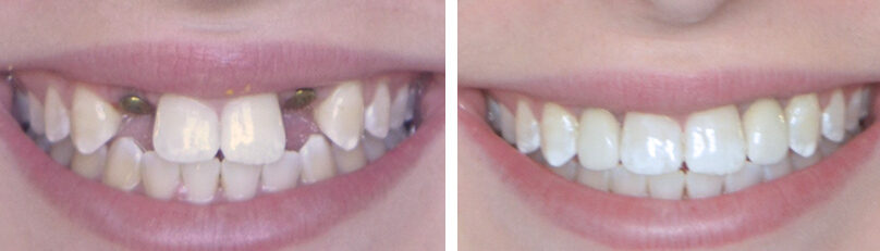 Before and after same-day implant