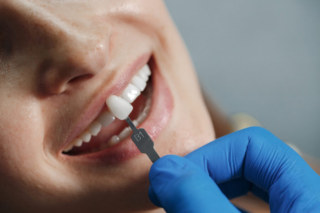 Dream Smile with Porcelain Veneers