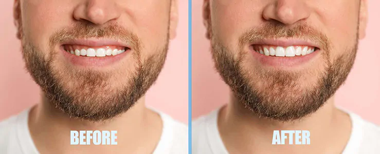 Before and after laser gum contouring
