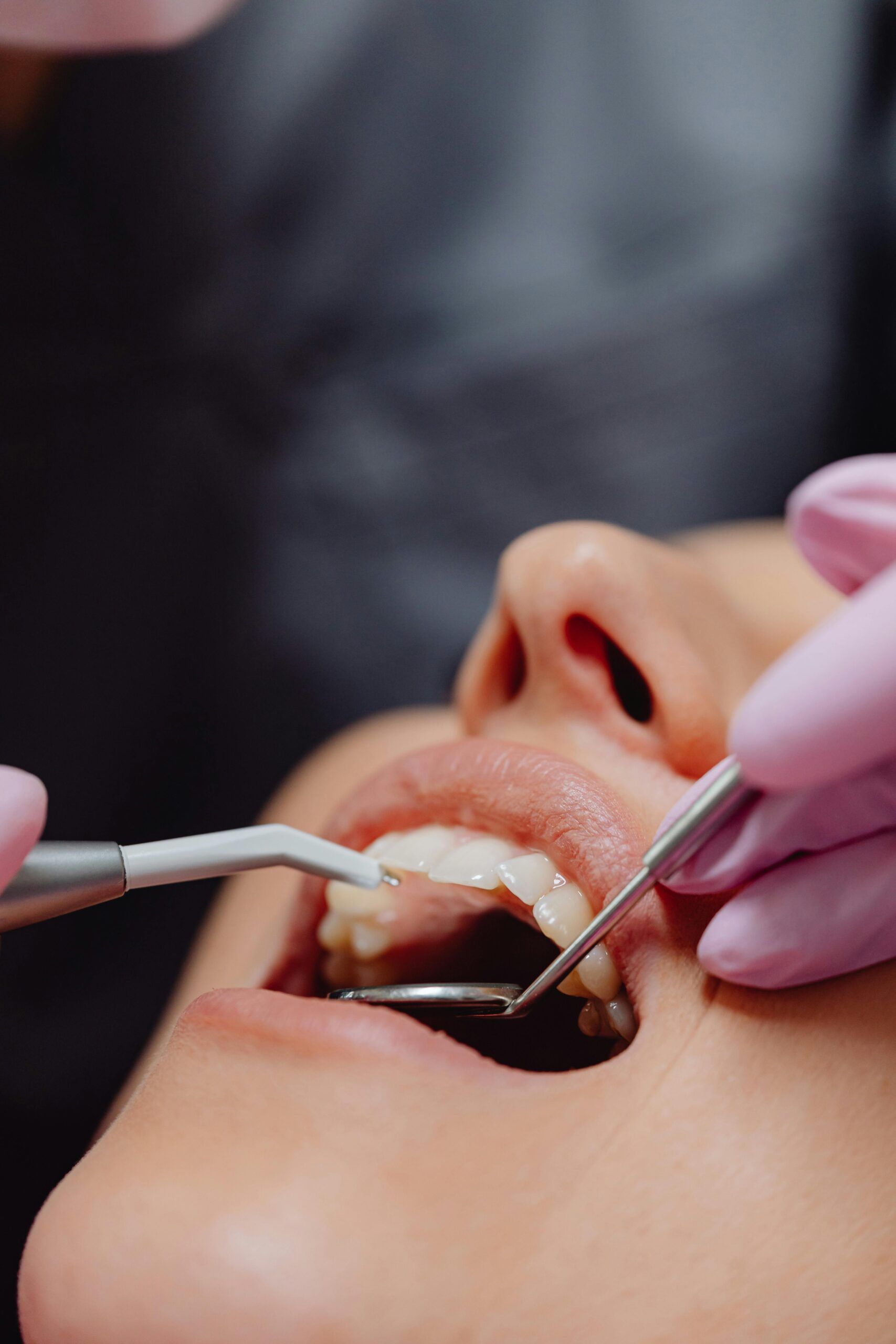 Fluoride treatment being applied