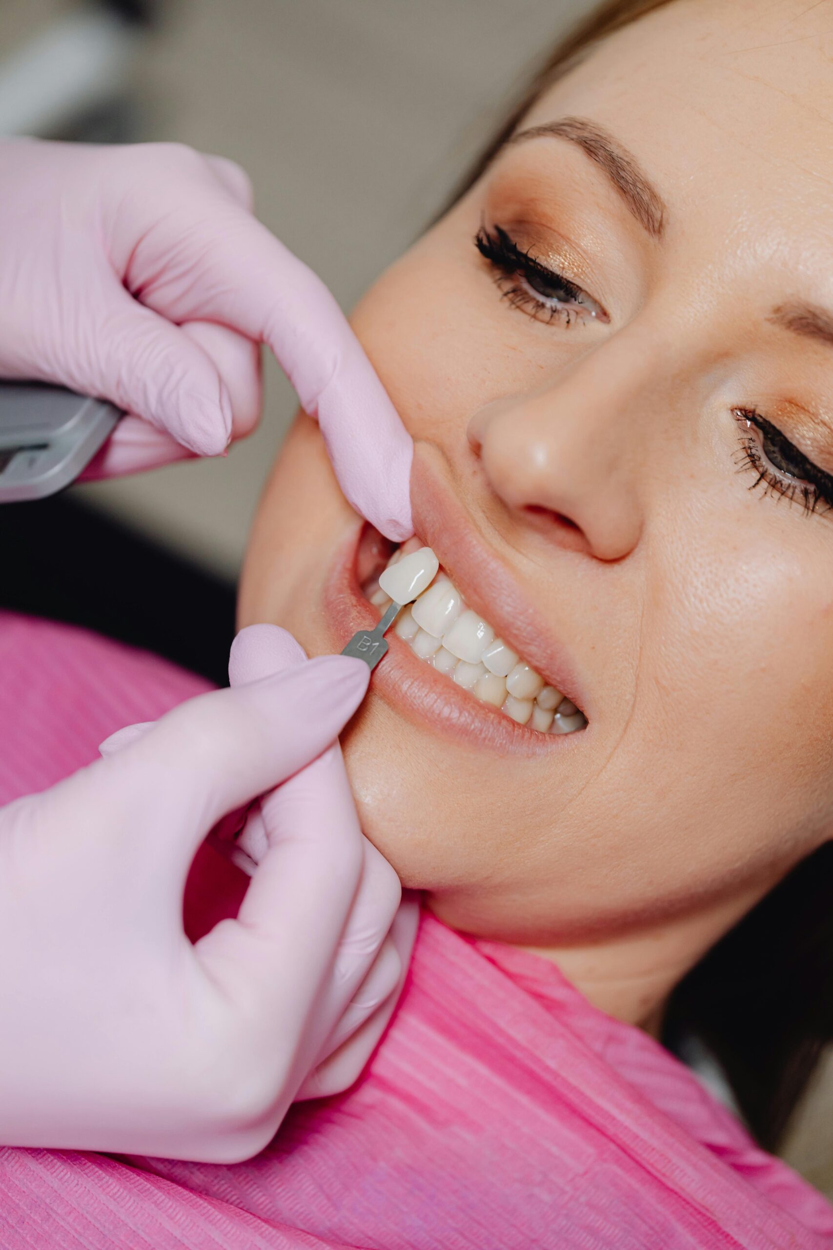 Matching an implant crown shade