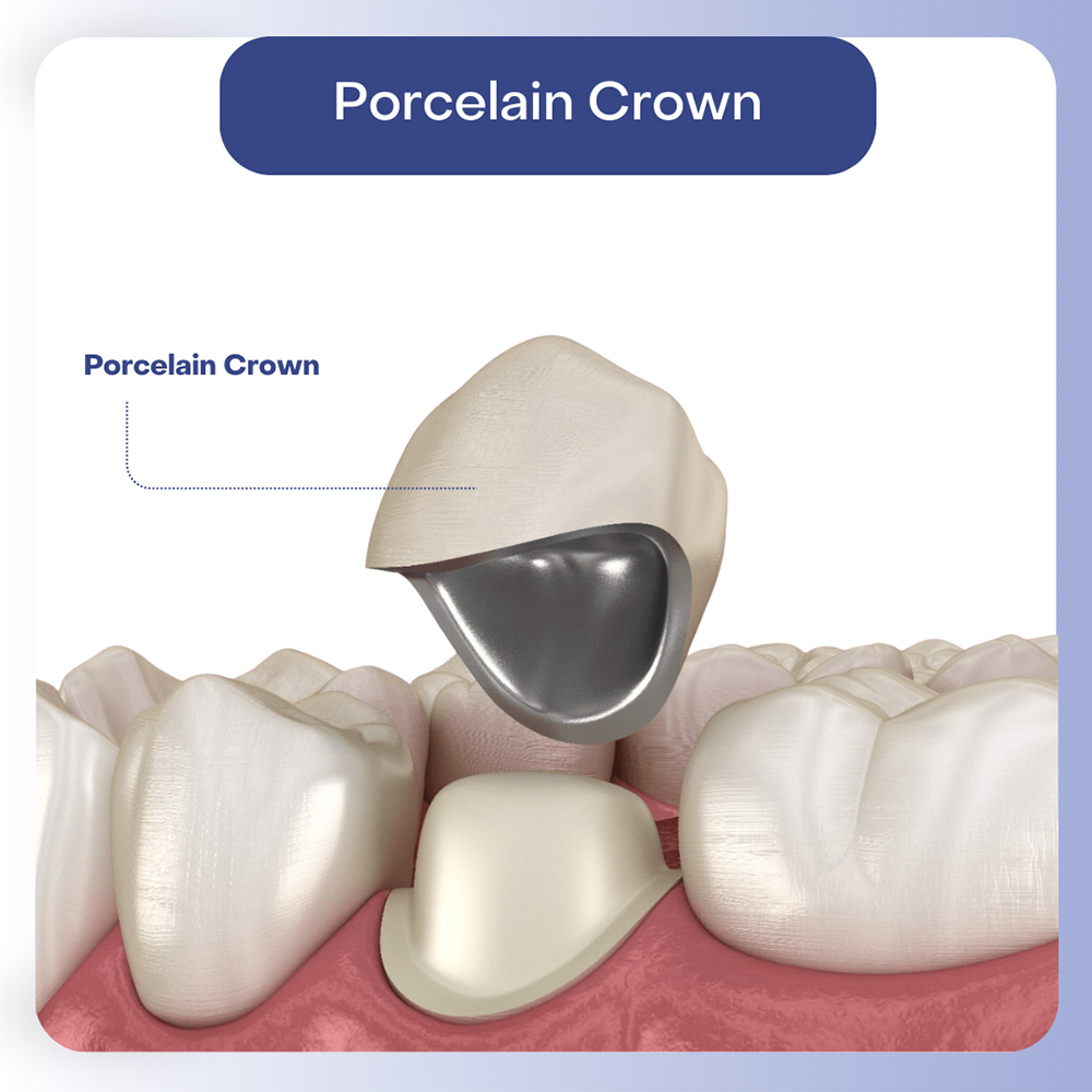 How a porcelain crown fits over a tooth