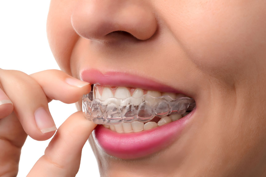 Clear Invisalign aligner
