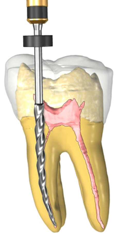 Root canal therapy illustration