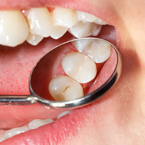 Tooth-colored composite filling
